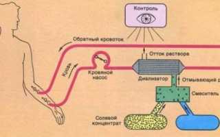Диализ почек что это